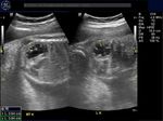 fetal-urogenital-sinus-persistent-cloaca