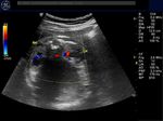 fetal-urogenital-sinus-persistent-cloaca