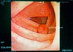 Colonoscopic view of the polyp