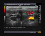 Long section ultrasound/ Power Doppler images of appendix