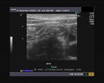 Long section ultrasound/ Power Doppler images of appendix
