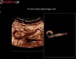 appendix-3D-ultrasound