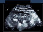 3-D Ultrasound image of renal calculus