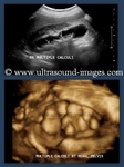 3-D ultrasound of multiple renal calculi