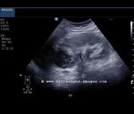 Long section ultrasound image of the left kidney