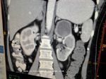 CT scan images showing the hemorrhagic cyst of the upper pole of the left kidney