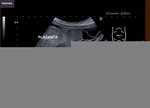 maternal horseshoe kidney in pregnancy