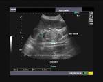 Ultrasound image- Left kidney- Chronic renal failure