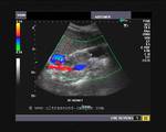 Color Doppler image Rt. kidney