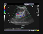 Color Doppler image- Left kidney