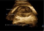 3D- Ultrasound image- Rt. subcapsular hematoma