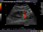 Power Doppler image of right kidney