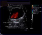 Color Doppler images of urinary bladder shows 2 right ureteric jets