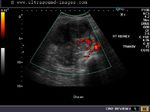 Power Doppler image of right kidney