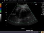 Right renal calculus: color Doppler image of XPN