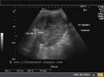 More ultrasound images of the right kidney