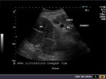 More ultrasound images of the right kidney
