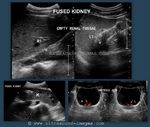 cross fused ectopic kidneys with duplex ureters