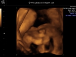 fetal face in 3d ultrasound- 25 weeks