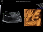 fetal face in 3d ultrasound- 25 weeks