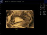 fetal sole of foot-3D ultrasound