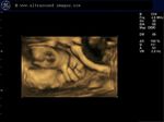 fetal fist-3D ultrasound