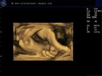 fetal fist-3D ultrasound
