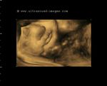 fetal face in coronal view-3D ultrasound