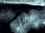 3D ultrasound image fetal lips