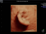 fetal ears in 3D ultrasound