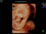 fetal yawn- 3D ultrasound