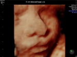 fetal yawn- 3D ultrasound