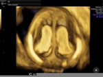 3D ultrasound images of fetal choroid plexus