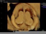 3D ultrasound images of fetal choroid plexus