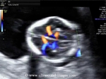 3D doppler ultrasound images of fetal circle of willis