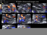 3D doppler ultrasound images of fetal circle of willis