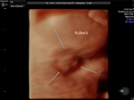 fetal-anus-3D-ultrasound