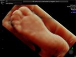 fetal-sole-of-foot-3D-ultrasound