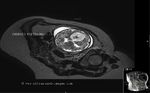 choroid-plexus-papilloma-MRI