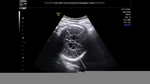 intraventricular-adhesions-fetal