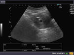 anembryonic-gestation