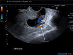 cervical-ectopic