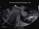 abdominal-ectopic-pregnancy