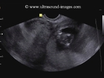 abdominal-ectopic-pregnancy