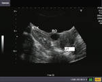 Bilateral ectopic (pelvic) kidneys