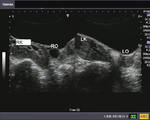 Bilateral ectopic (pelvic) kidneys