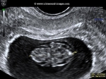 fetal-hydrops-10weeks