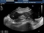pedunculated-fibroid