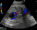Fetal intra-abdominal umbilical vein varix