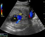 Fetal intra-abdominal umbilical vein varix